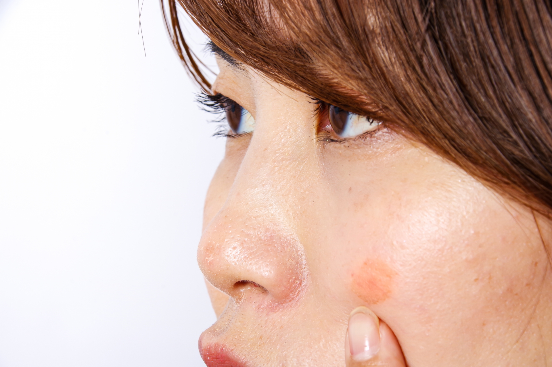 西東京の皮膚科・美容皮膚科によく持ち込まれるお悩み⑭粉瘤